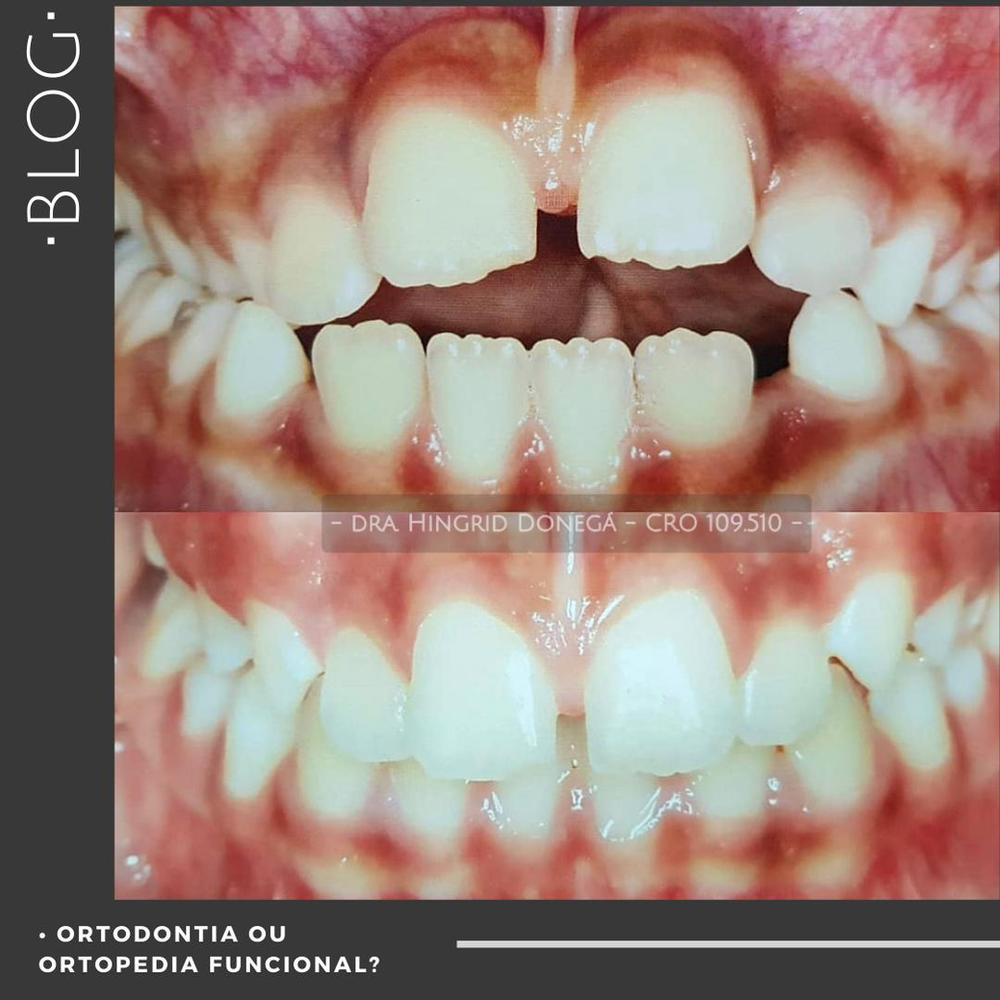 Ortodontia e Ortopedia Funcional dos Maxilares - Dente Chic