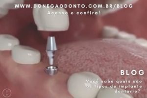 Quais os modelos de implantes dentários?