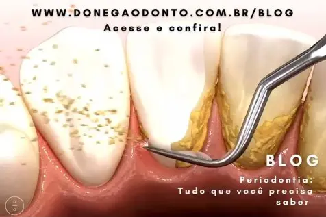 Tudo o que você precisa saber sobre a Periodontia