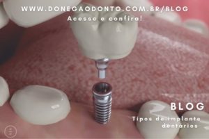 Conheça os principais tipos de implantes dentários