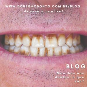 Manchas nos dentes: o que são?