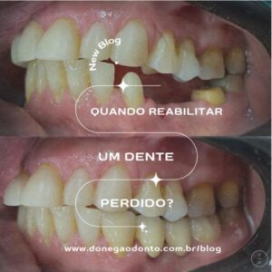 Como reabilitar dentes perdidos?