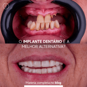 implantes dentário donegá odonto - dra hingrid