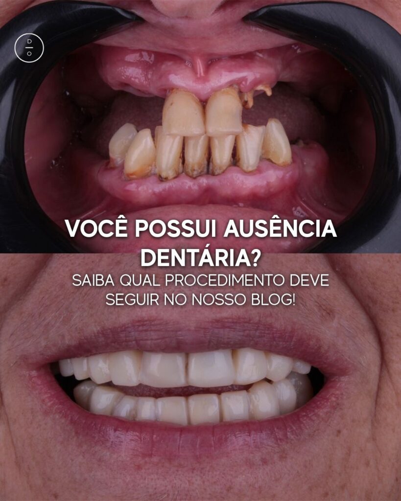 Ausência dentária o que fazer?